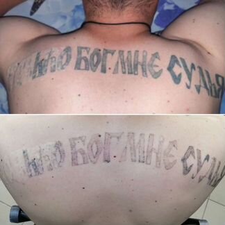 Удаление татуировок и татуажа. Карбоновый пилинг